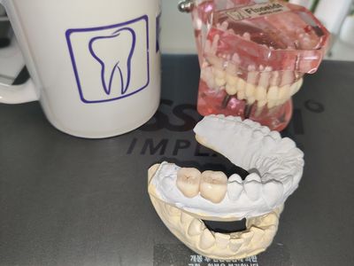 Fluoride Dental Care - Dentist in Kharadi | Implant Centre | Root Canal | Kids Dentist | Braces | Tooth ache